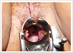 Candidiasis Vaginal