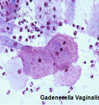 Gadenerella Vaginalis