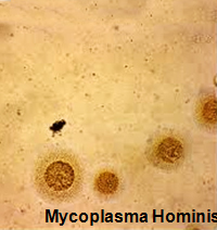 Mycoplasma Hominis