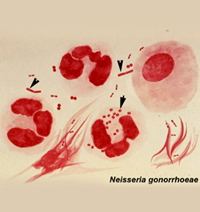 Neisseria Gonorrhoeae