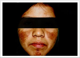 Melasma Severo