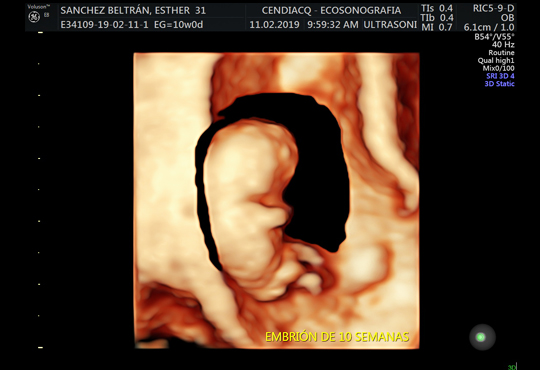Ecografía 5D - Embrión 10 semanas