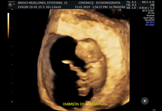 Ecografía 5D - Embrión 13 semanas