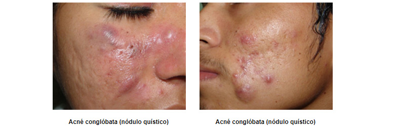 a quienes afecta el acné