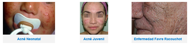 a quienes afecta el acné
