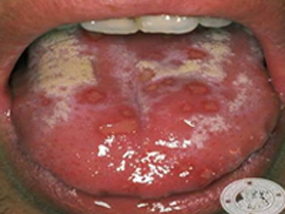 Herpes Oral: Primoinfección