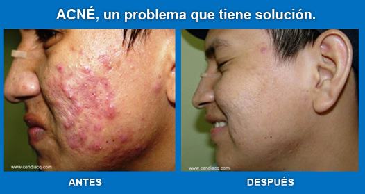 tratamiento para el acne en guayaquil